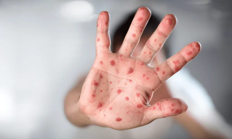 Casos de viruela símica detectados en el destacamento de San Cristóbal donde murió hombre por leptospirosis